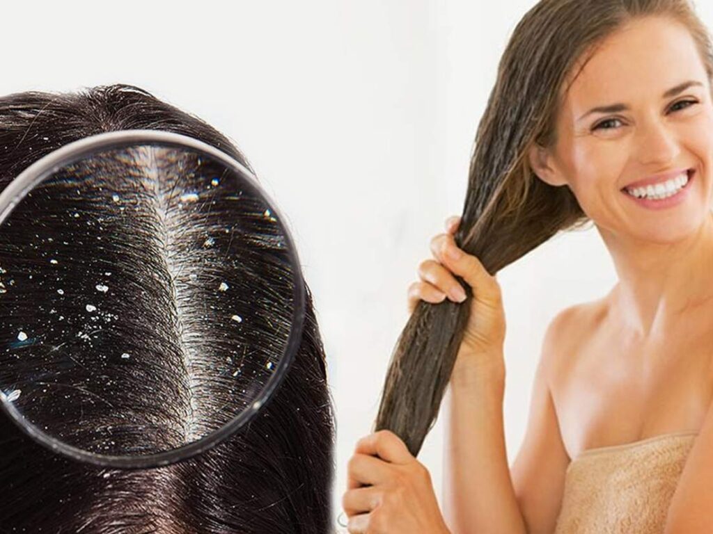 reduce dandruff naturally