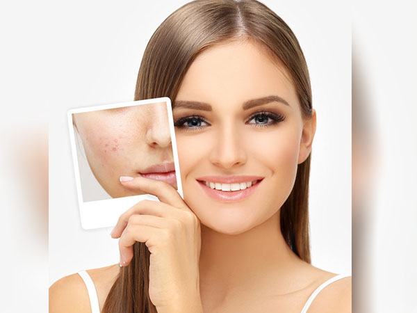 16 Best Pimples Home Remedies|पिंपल्स का येतात ?पिंपल्स आल्यावर काय करावे?चेहऱ्यावरील पिंपल्स जाण्यासाठी १६घरगुती उपाय